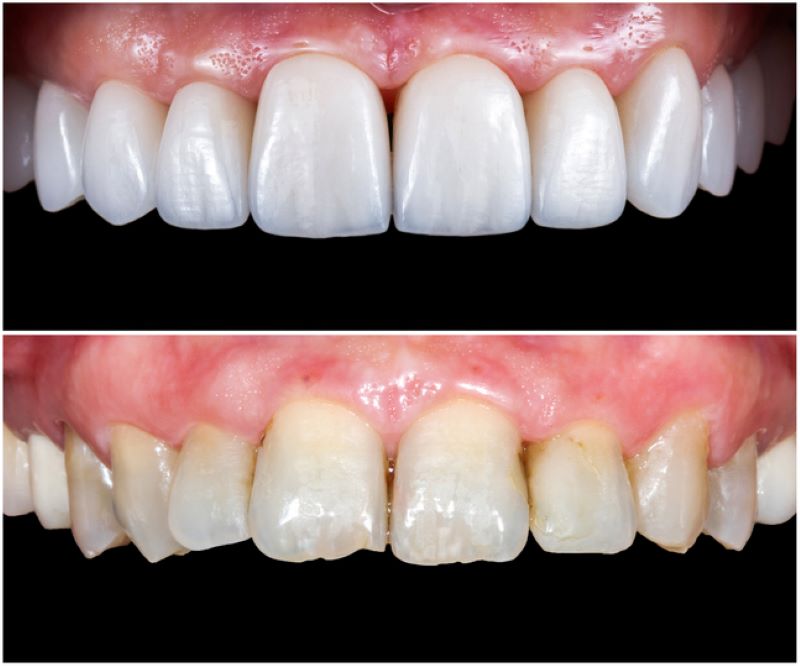 before and after close-up of dental veneers Wetherill Park