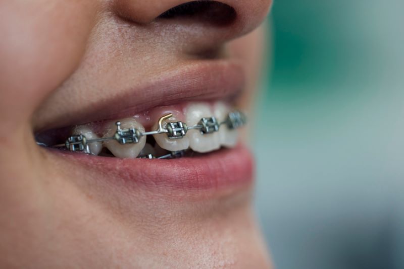 Braces in Wetherill Park – Achieve a Straighter, Healthier Smile