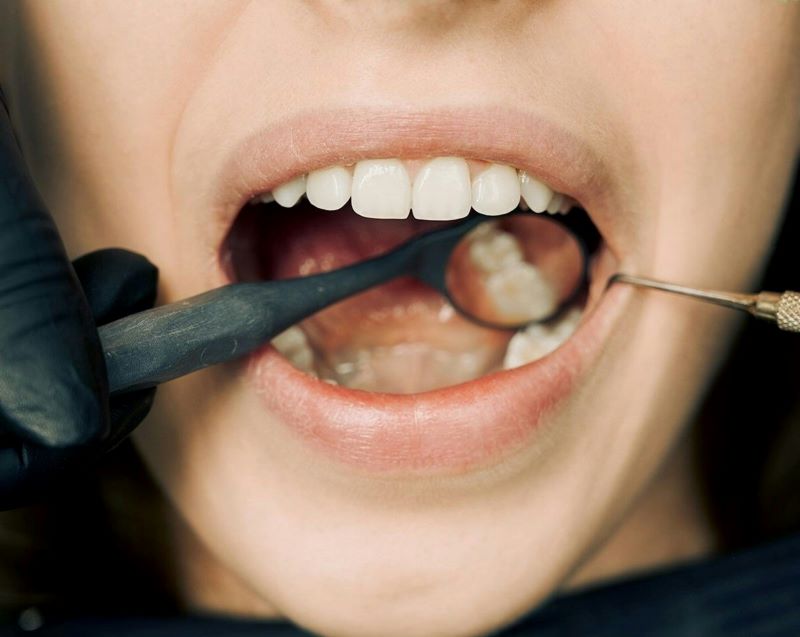 Dental Crowns in Wetherill Park – Restore and Protect Your Teeth with Confidence