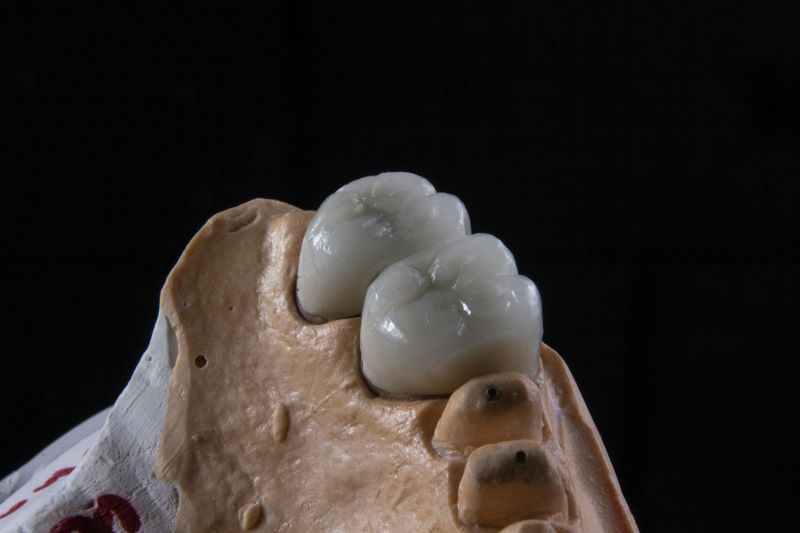 close-up of dental crown Wetherill Park treatment