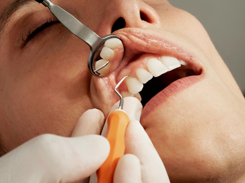 Dental Fillings – Restore Your Smile at Our Wetherill Park Dental Clinic