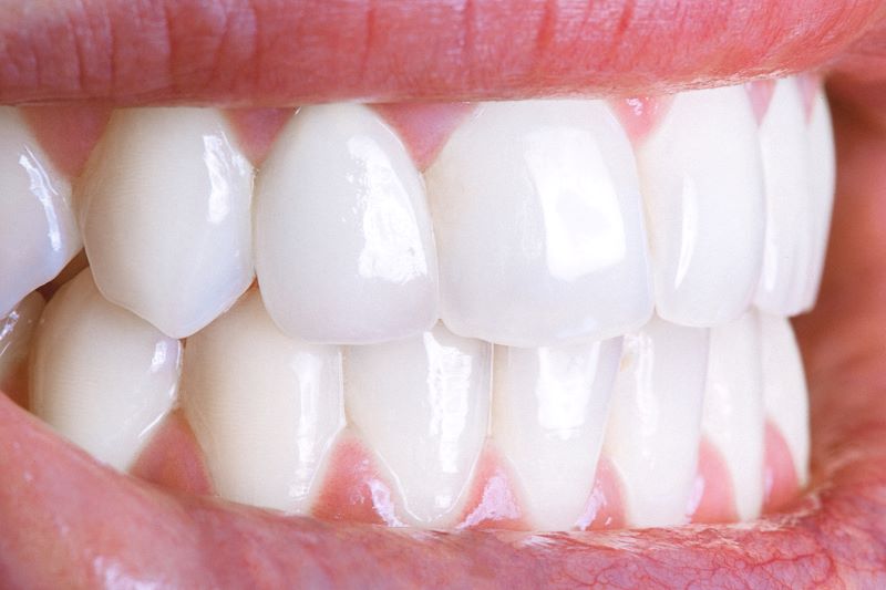 Smile Makeover Wetherill Park – Transform Your Smile with Confidence