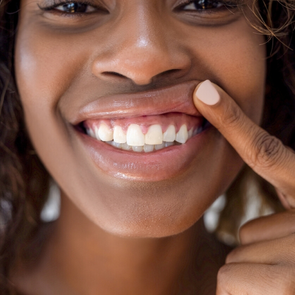 service-gummy-smile-dentist-wetherill-park Woman smiling and showing gums with finger – gummy smile example at Wetherill Park dental clinic.