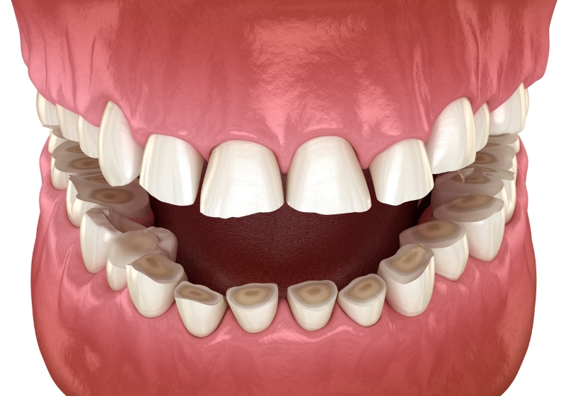 Illustration of worn-down teeth caused by bruxism and grinding without a night guard