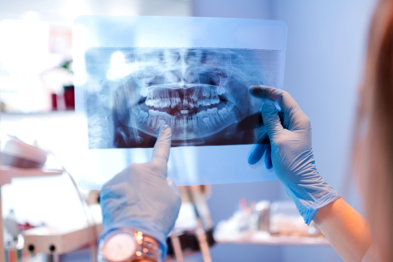 Do You Really Need Dental X-Rays? What They Reveal About Your Oral Health