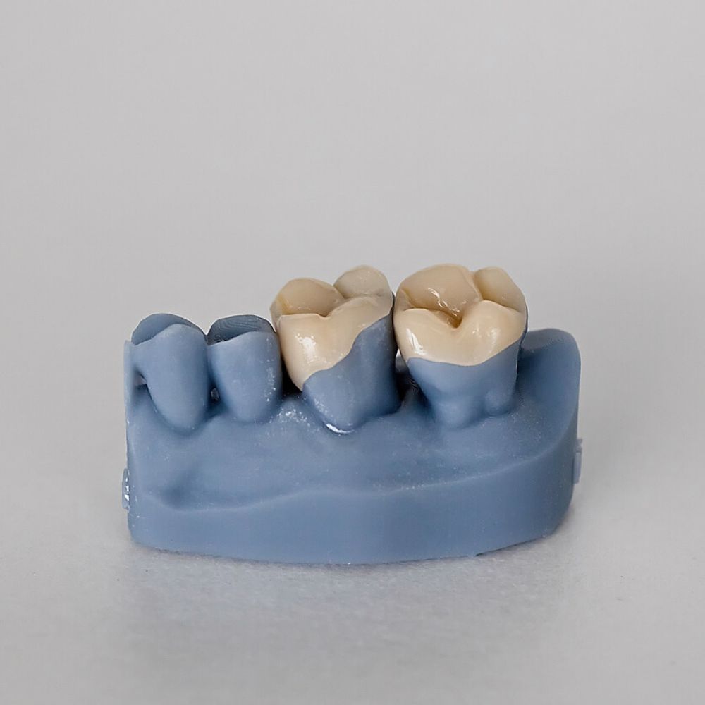 service-inlays-onlays-dentist-wetherill-park Dental model showing tooth-coloured ceramic inlays and onlays for restorative treatment at Dr Raymond Platon & Associates in Wetherill Park.