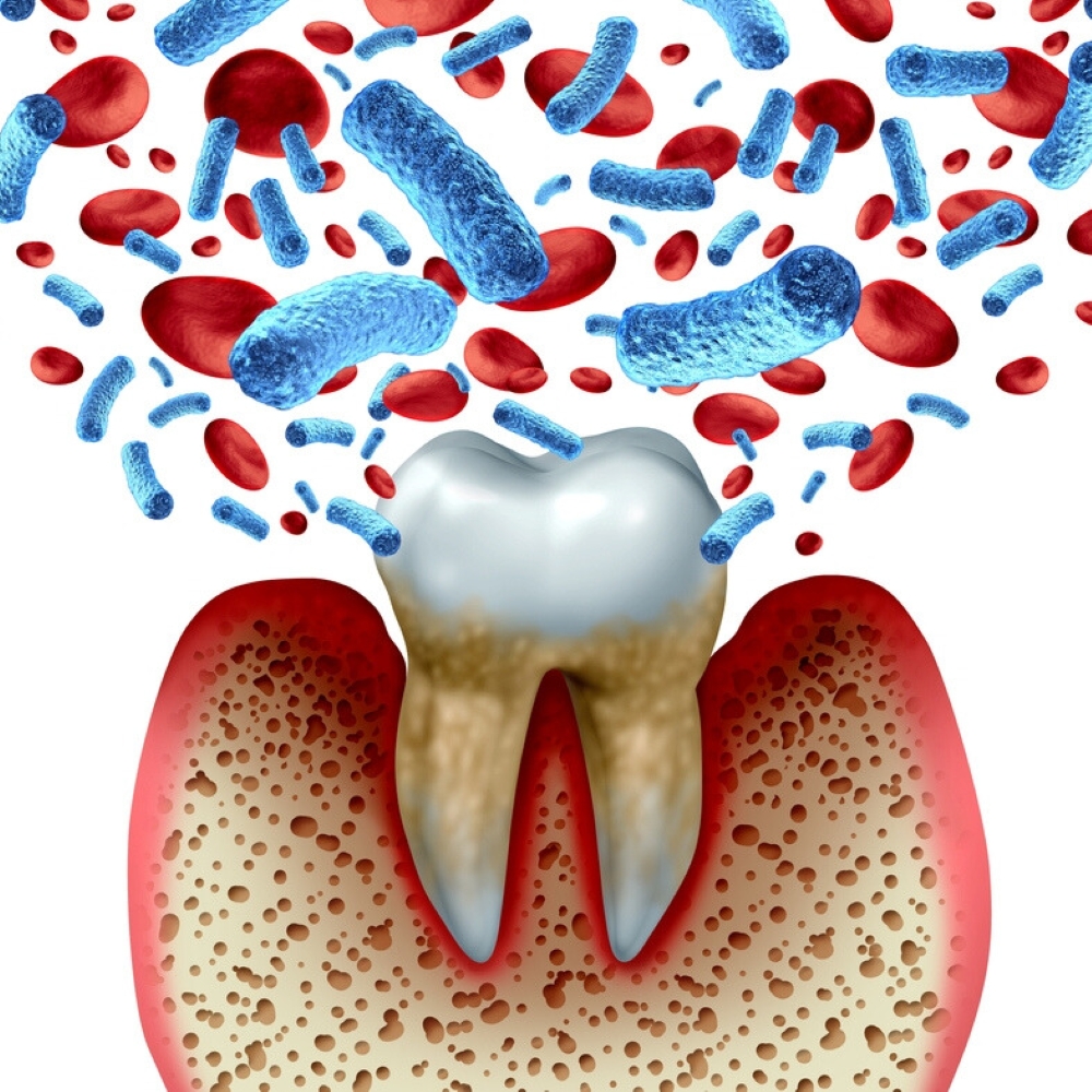 service-periodontal-therapy-dentist-wetherill-park Illustration of gum disease with bacteria and inflamed gums around a tooth.