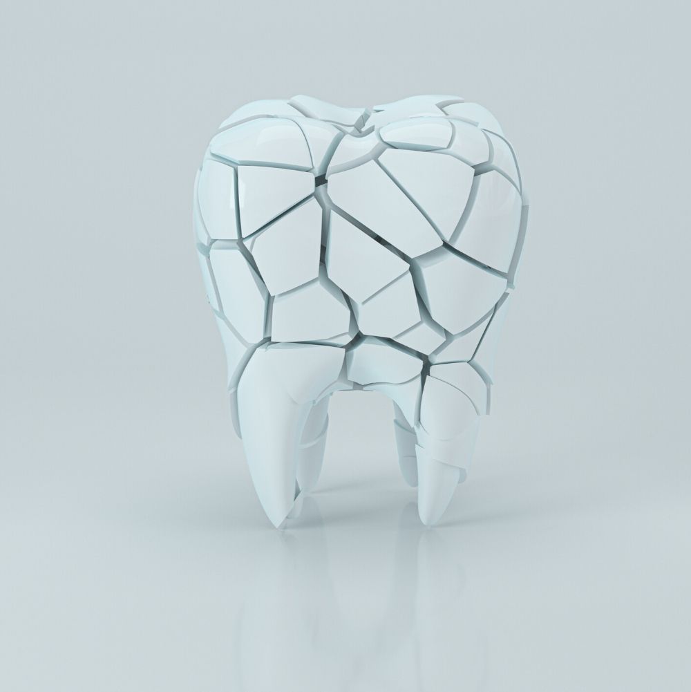 Cracked tooth illustration representing broken or chipped tooth treatment at Dr Raymond Platon & Associates in Wetherill Park.
