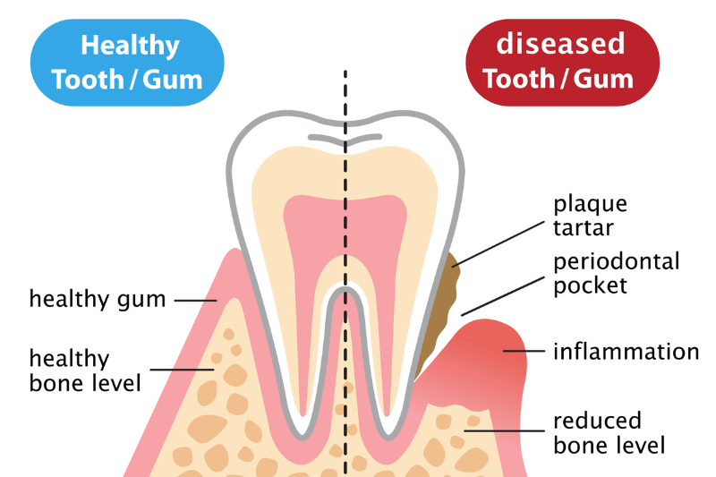 Diagram showing healthy and diseased gums to explain gum recession at our Wetherill Park dental clinic