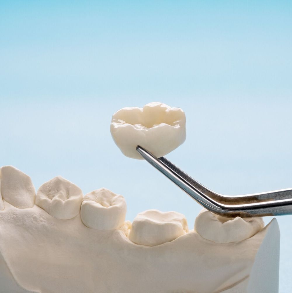 Dental crown restoration at Wetherill Park dentist showing crown placement on tooth model