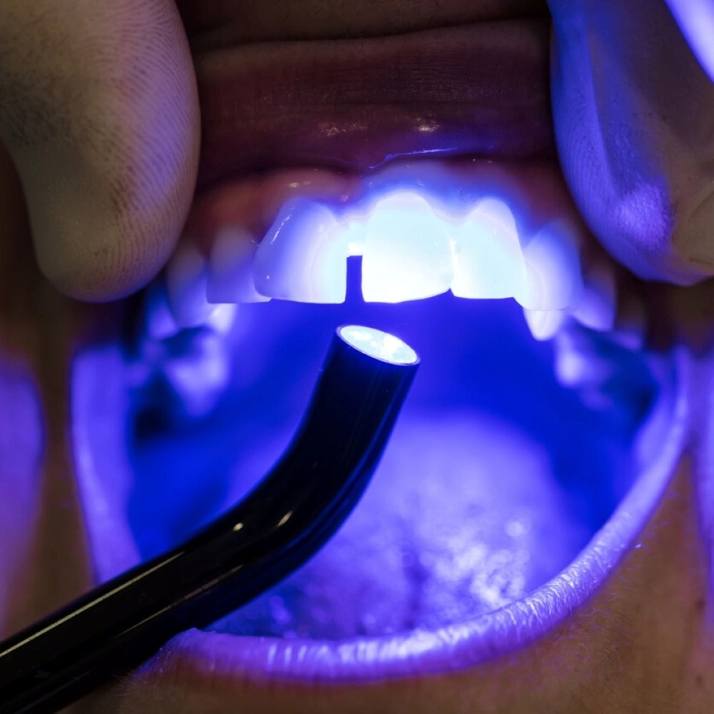 Dentist applying cosmetic bonding with curing light – Wetherill Park dental clinic.
