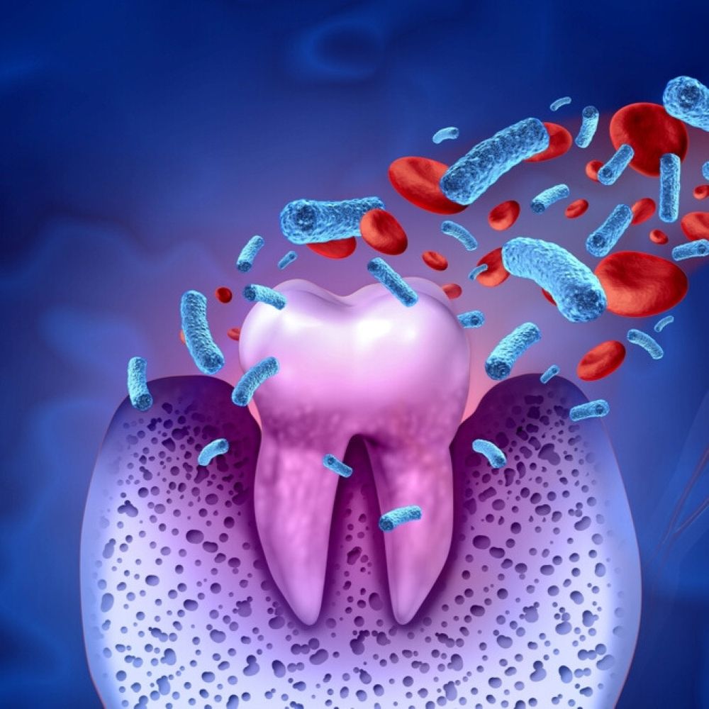 Laser Bacterial Reduction Wetherill Park – illustration showing bacteria and infection around a tooth and gums.