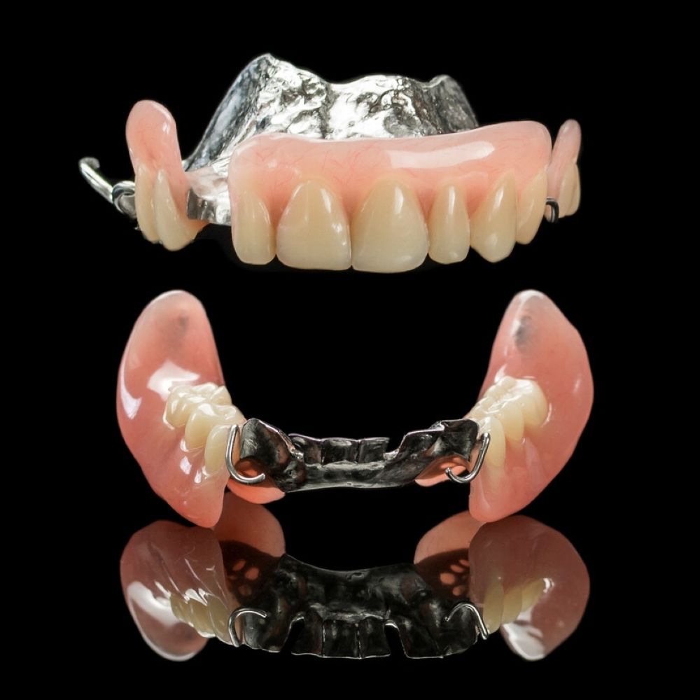 Removable partial denture with metal framework and acrylic teeth - Wetherill Park dentist.