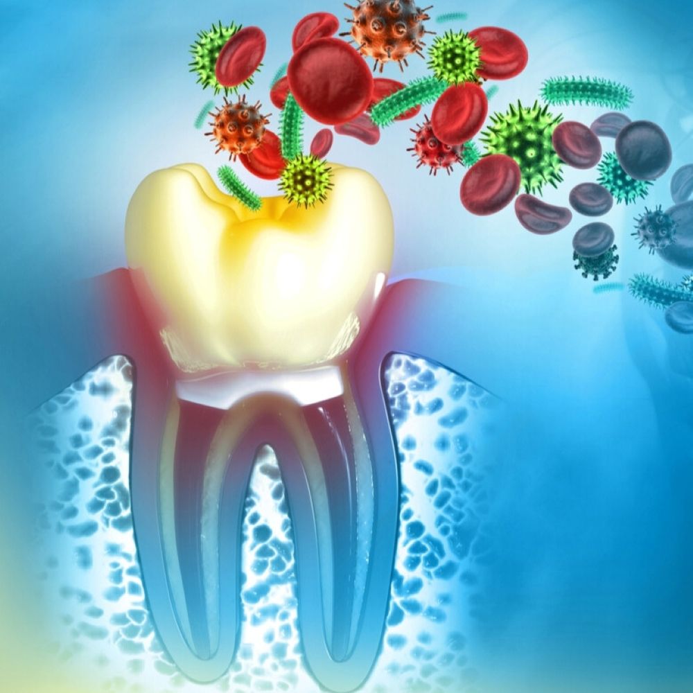 Illustration showing gum infection with bacteria and inflammation around a tooth root – representing gum disease treatment in Wetherill Park.