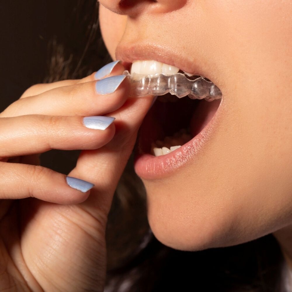 Woman inserting clear dental retainer – retainers in Wetherill Park.