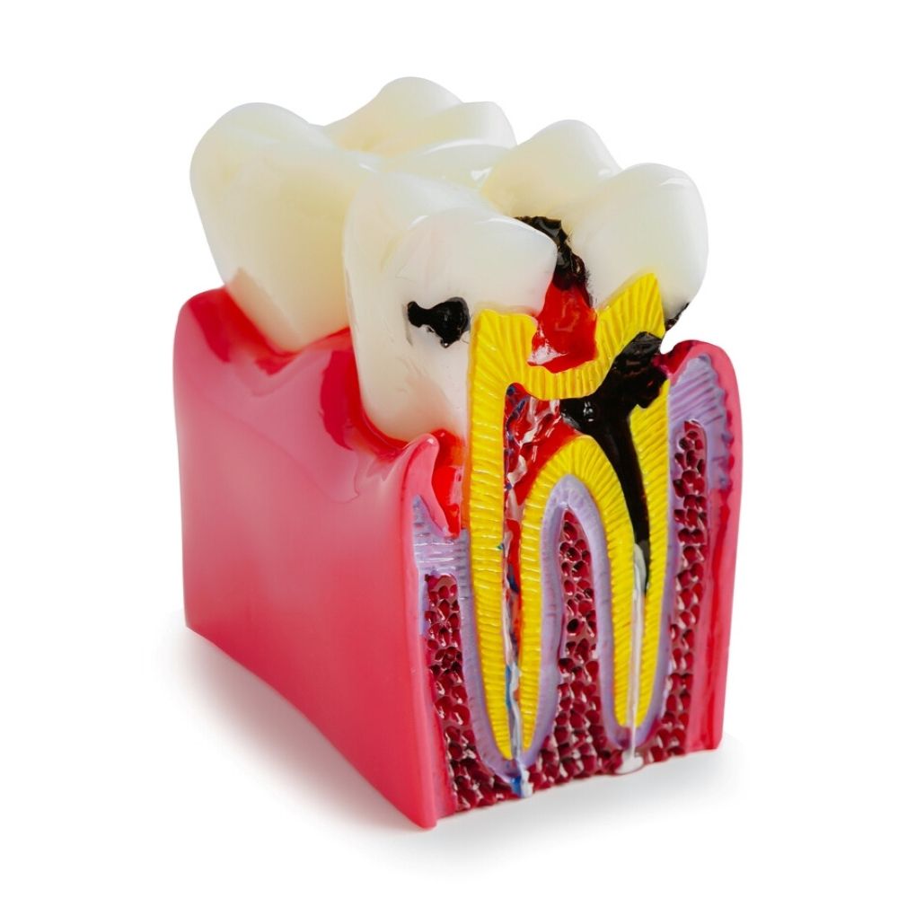 Root canal Wetherill Park - 3D model showing infected tooth nerve and treatment illustration.