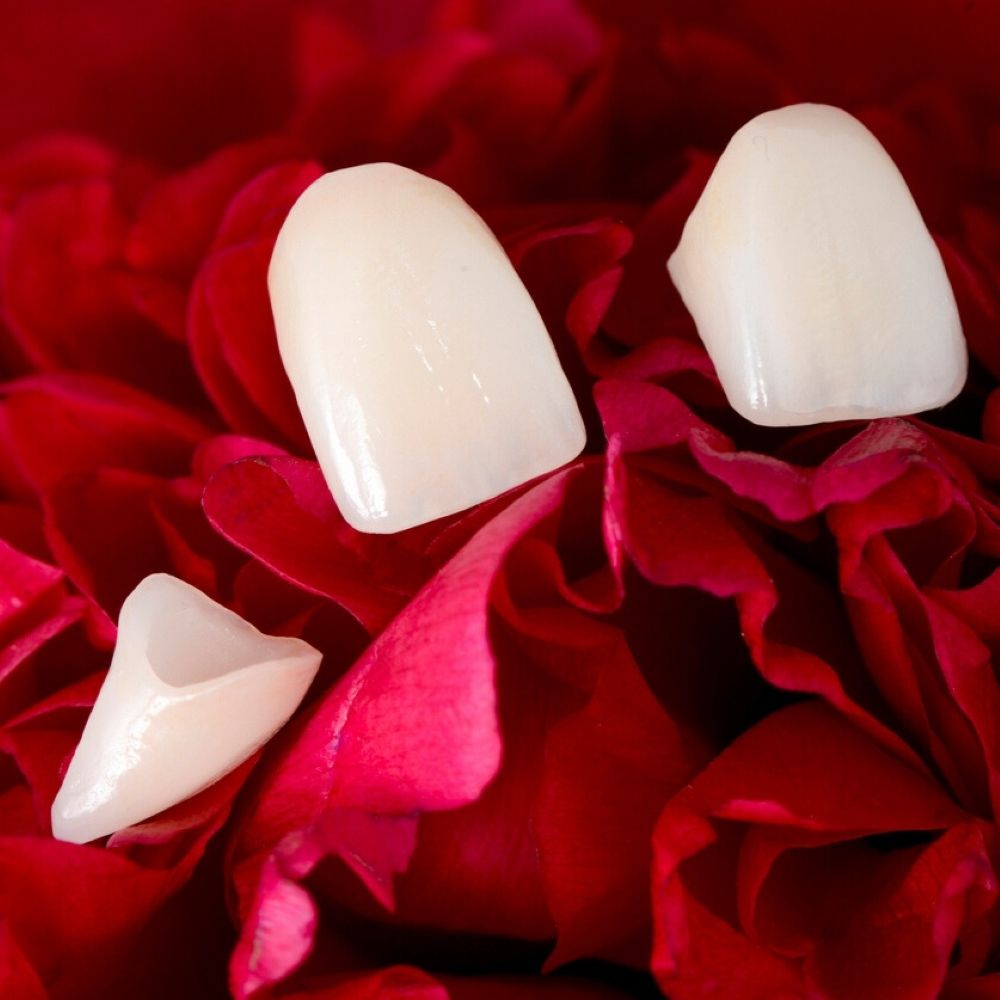 Porcelain dental veneers on red rose petals – cosmetic dentistry in Wetherill Park.