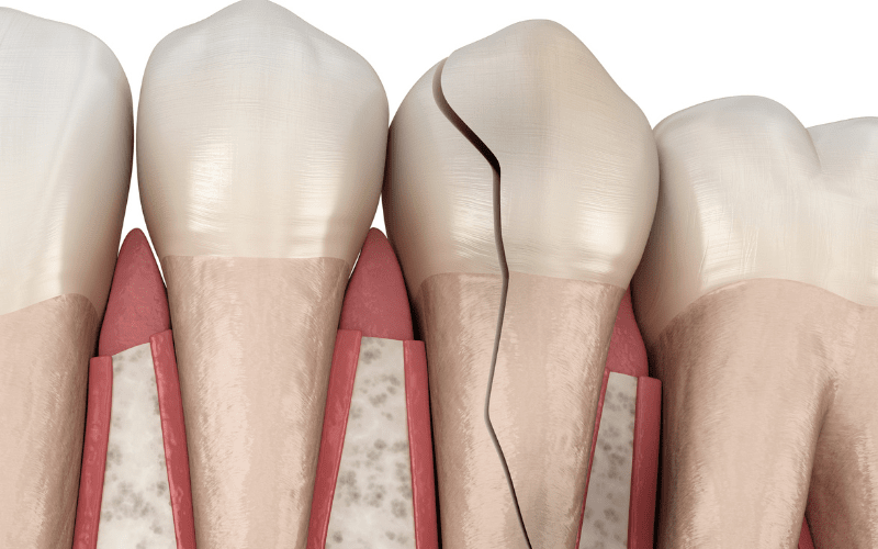Cracked tooth causing tooth pain when biting 
