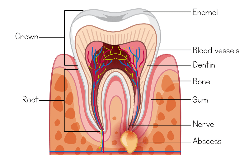 Dental abscess diagram showing infection under the gum and tooth root in Wetherill Park