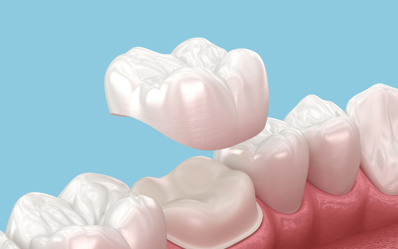 Dental crown replacement restoring tooth strength and comfort after tooth pain when biting in Wetherill Park