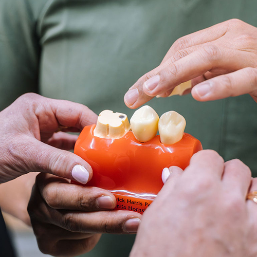 Dental crowns treatment model used during restorative dentistry in Wetherill Park