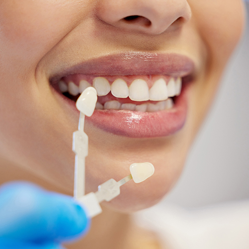 Dental veneers treatment demonstrating smile enhancement in Wetherill Park