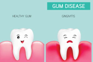 Early gum inflammation without bleeding affecting the gum line