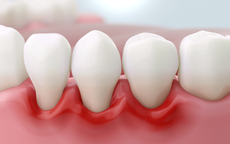 Early gum recession showing exposed tooth roots without bleeding