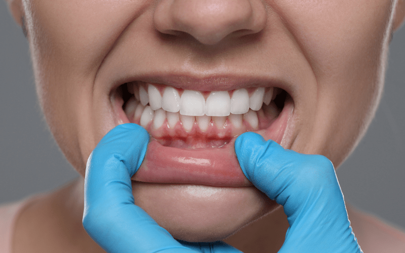 Gum Recession in Wetherill Park – Causes & Treatment