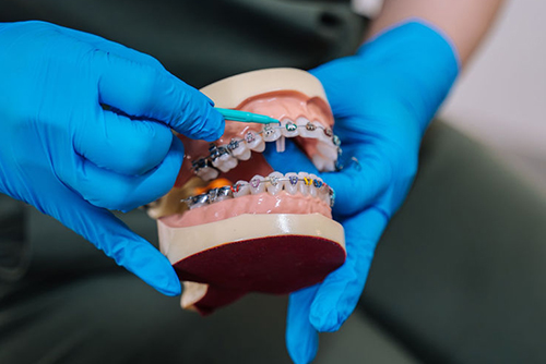 Orthodontic treatment model demonstrating braces in Wetherill Park