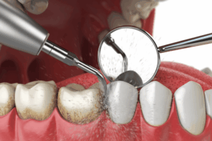 Professional dental cleaning removing plaque build up to relieve sore gums without bleeding