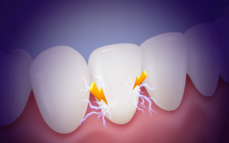 Illustration showing tooth nerve pain when biting due to pressure on an inflamed tooth in Wetherill Park 