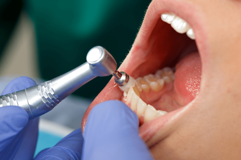 Swollen gums being treated by a dentist in Wetherill Park during a professional dental examination