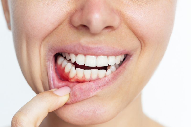 Swollen Gums in Wetherill Park – Causes, Treatment and When to See a Dentist