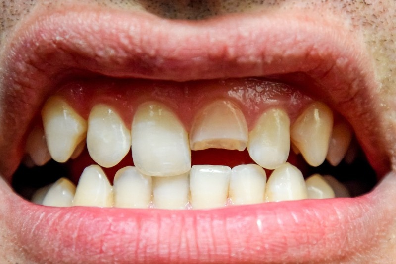 Broken Tooth in Wetherill Park: What to Do Immediately