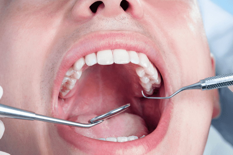 emergency dentist treating tooth infection Wetherill Park dental procedure close up