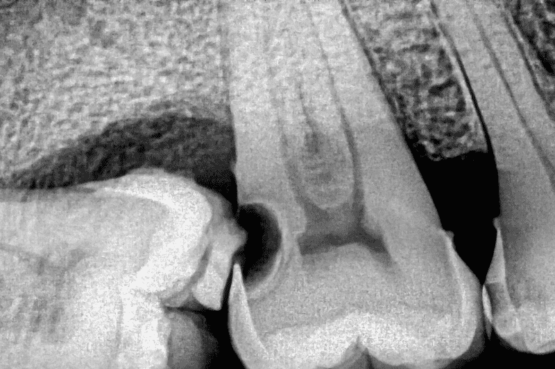 tooth infection symptoms Wetherill Park shown on dental x ray with root infection