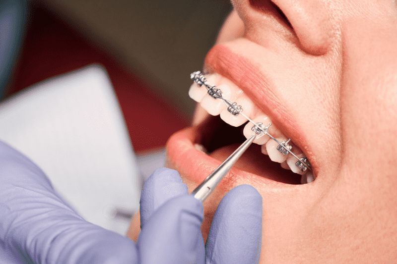 orthodontic braces adjustment Wetherill Park dentist treatment