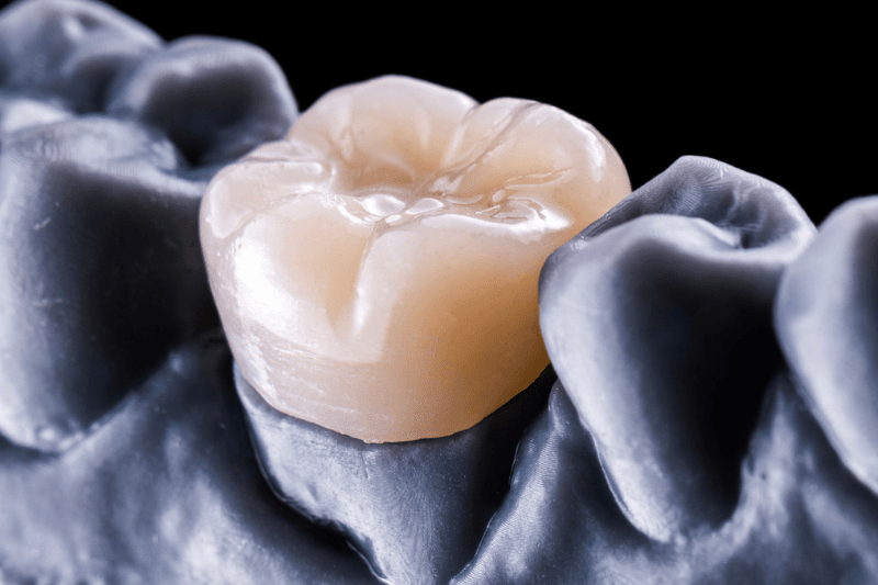 Zirconia dental crown protecting a damaged tooth in Wetherill Park
