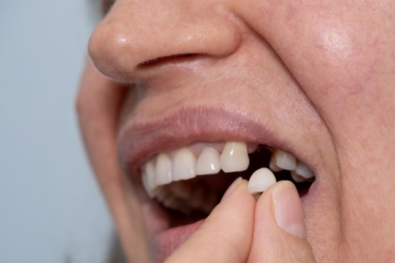 Can a Missing Tooth Affect the Rest of Your Teeth in Wetherill Park?