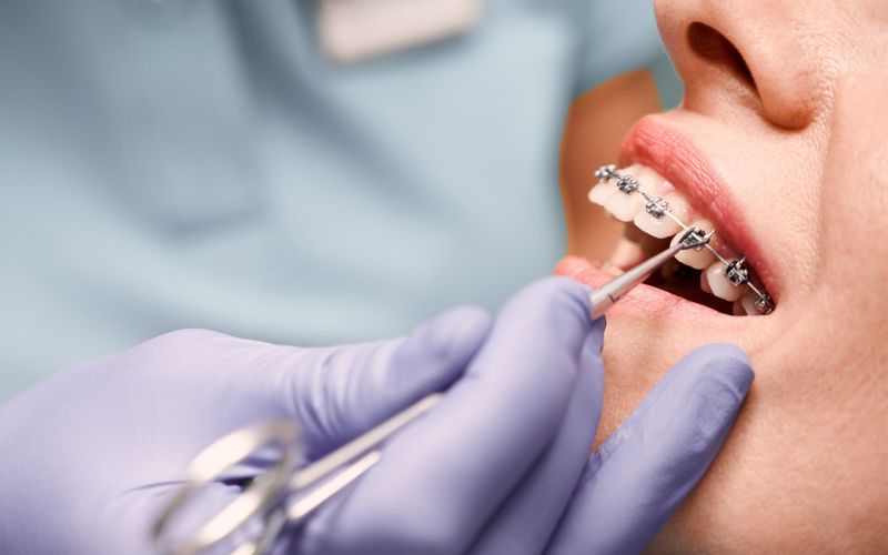 Fixed braces being adjusted during an orthodontic appointment