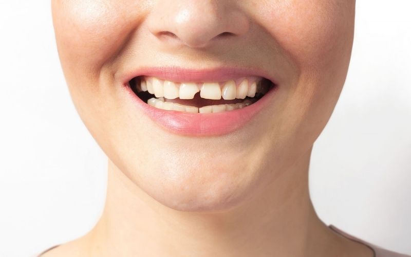 Chipped Front Tooth: Can It Be Bonded, Veneered or Crowned?