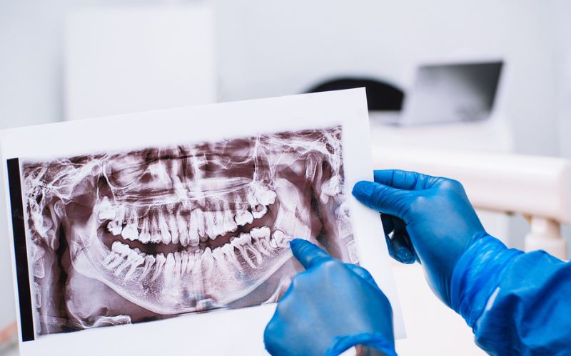 Do Wisdom Teeth Need to Be Removed? What a Check Up Can Tell You