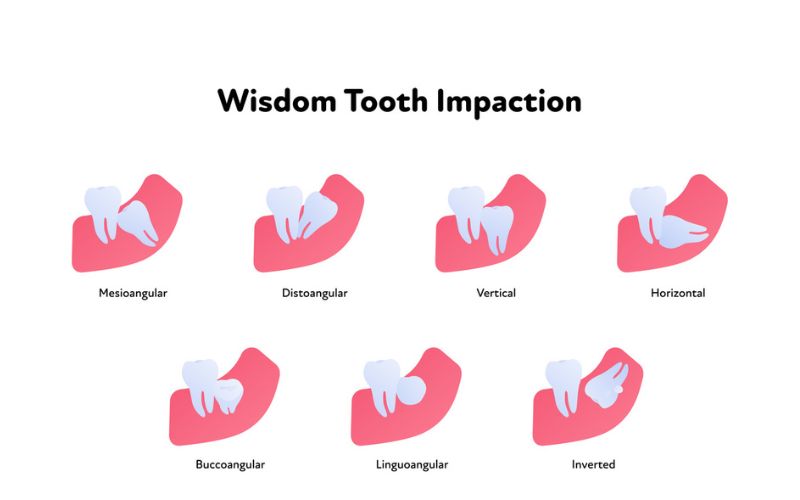 Different types of wisdom tooth impaction including horizontal and angled positions