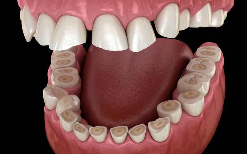 Dental attrition from bruxism showing loss of tooth tissue and flattened biting surfaces