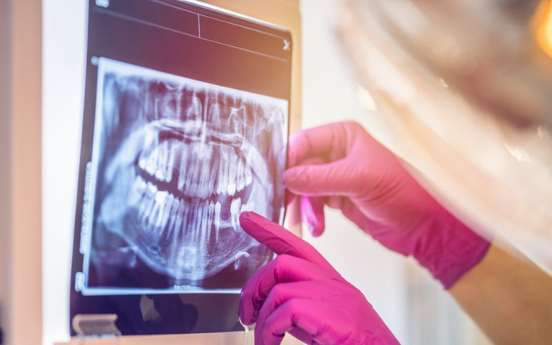 Dentist reviewing a dental radiograph as part of implant assessment and treatment planning