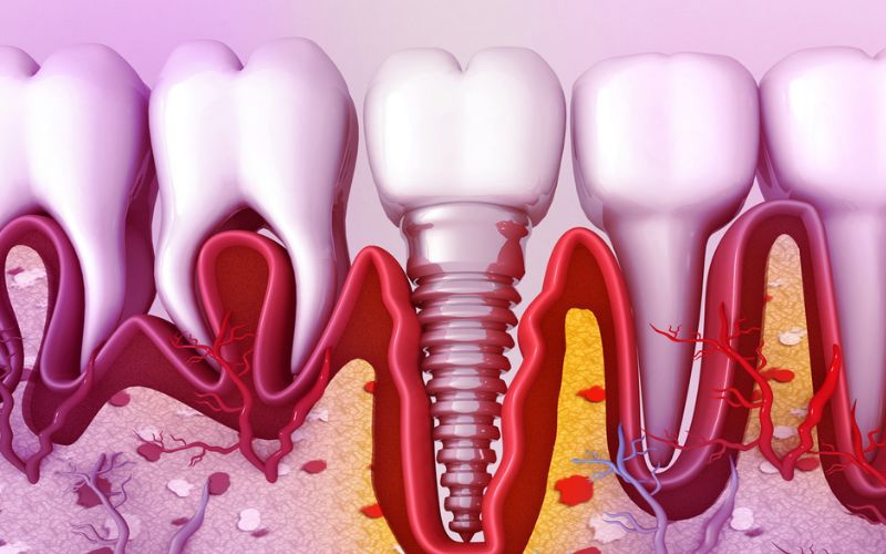 Dental implant positioned in jaw bone during the osseointegration healing process