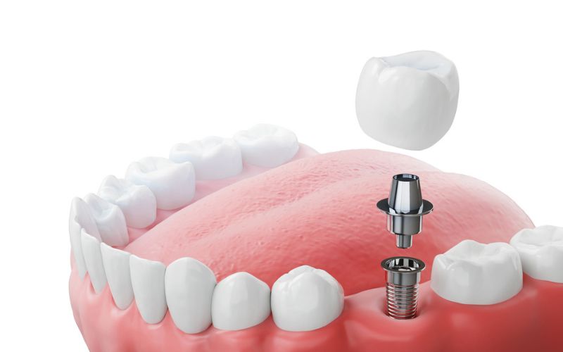 Single tooth dental implant with crown positioned to replace one missing tooth