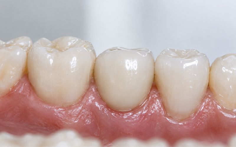 Completed single tooth implant restoration with abutment and dental crown