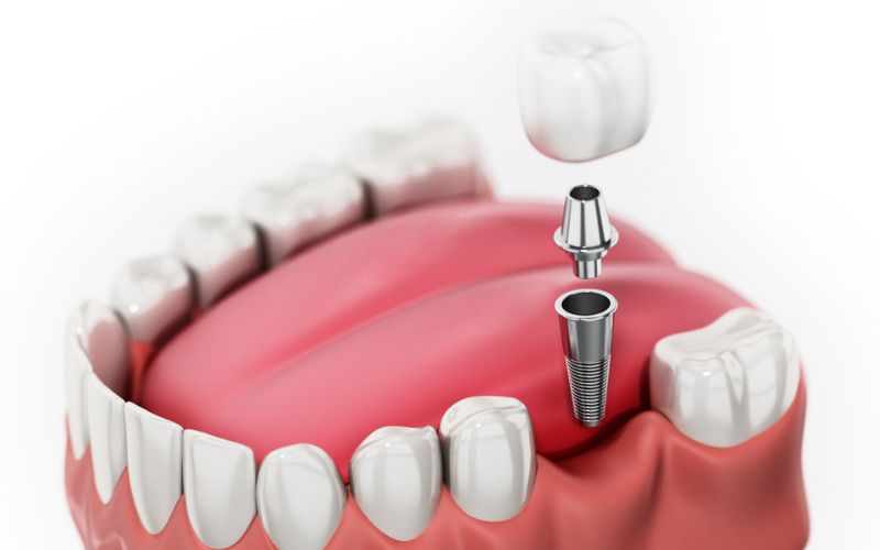 Getting a Single Tooth Implant: Procedure, Healing and What to Expect
